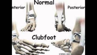 positional talipes treatmenttalipes equinovalgus treatmenttalipes calcaneus treatment for clubfoot [upl. by Ibrek]