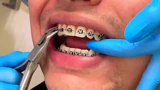 Comment retirer lappareil orthodontique [upl. by Osbourn]