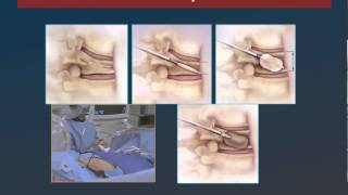 Radiología Intervencionista de la Columna Vertebral [upl. by Rosabel]