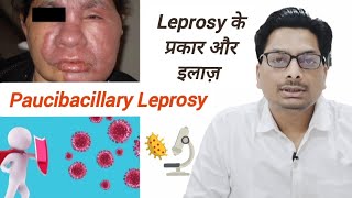 Paucibacillary Leprosy  Leprosy के प्रकार और इलाज़  नसों को नुकसान पहुंचाने वाली कुष्ट रोग leprosy [upl. by Atnauq]