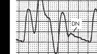 Timing and triggering of the Intraaortic Balloon Pump IABP [upl. by Forrester968]