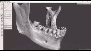 Convert Dicom CT to STL file 3D printable [upl. by Keri]