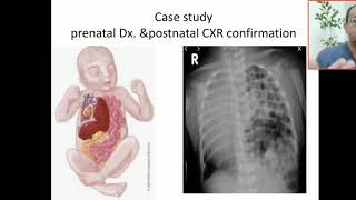 Case 47 congenital diaphragmtic hernia bochdalek hernia morgagni hernia [upl. by Ardenia]