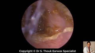 Top Biggest Ear Wax Removal 92  Ear wax Extraction  Dr S Thouk Earwax Specialist [upl. by Andrade547]