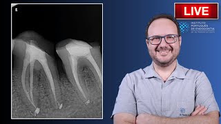 Endo Treatment of 🦷36 with irreversible pulpitis due to bruxism  PT2 [upl. by Apicella344]