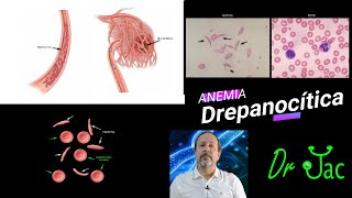 Anemia falciforme o Drepanocítica [upl. by Ennovyhc]