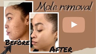 Mole Removal Vlog start to finish What to expect DPN removal BeforeampAfter care tips [upl. by Burrill]