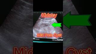 Kidney Cysts on Ultrasound  how to diagnose simple Renal Cyst shorts [upl. by Olodort538]