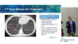 Overview of Bronchiectasis [upl. by Donnie273]