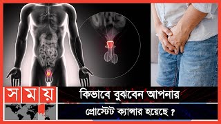 প্রোস্টেট ক্যান্সার ও বর্তমান চিকিৎসা পদ্ধতি  Prostate Cancer  Somoy TV [upl. by Edmead]