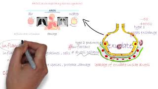 ARDS acute respiratory distress syndromeشرح [upl. by Alta]