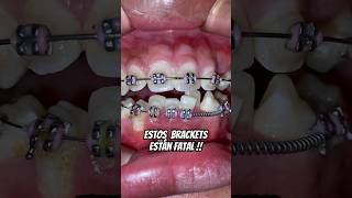 La peor colocación de Brackets 😱 brackets dentista [upl. by Noivad]