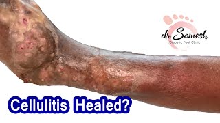 cellulitis infection  Necrotizing Fascitis Healing Stages [upl. by Ahsoj]