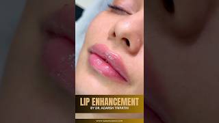 Amazing Plump Lips With Lip Fillers  Sarayu Clinics fillers [upl. by Natal]