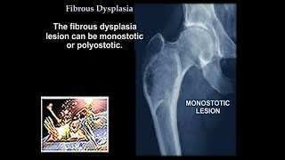 Fibrous Dysplasia  Everything You Need To Know  Dr Nabil Ebraheim [upl. by Neelsaj816]