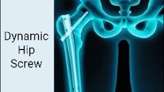 Dynamic Hip Screw Surgical Technique and Rehabilitation Tips [upl. by Ardnaxela675]