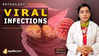 Viral Infections  Mumps  Pathology Video Lectures  Medical VLearning  sqadiacom [upl. by Ahseka]