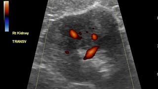 Echogenic renal mass renal cell carcinoma or Angiomyolipoma Ultrasound and color Doppler video [upl. by Jenda]