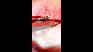 Tonsil Stones Removal Procedure [upl. by Alyar221]