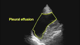 NEJM US guided thoracentesis [upl. by Adnamor131]