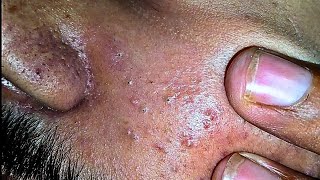 sac be spa blackheads elderly 2024  sac be spa old age blackheads 2024  sac be spa thuy 345 [upl. by Amy]