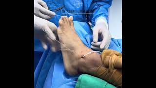 Combined Medial and Lateral Augmentation Ligament Reconstruction of the Ankle 100 PERCUTANEOUS [upl. by Ylirama]