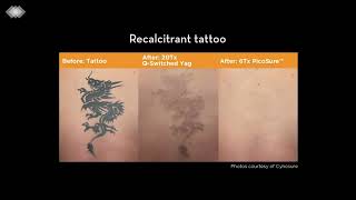 PicoSure Laser Tattoo Removal [upl. by Mann]