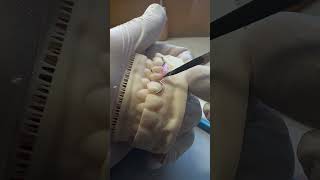 Micro DENTURE with clasps dentist polishing teeth dentures dentistry [upl. by Sidky]