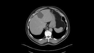 Esophagus  Leiomyoma distal esophagus [upl. by Nnailuj907]