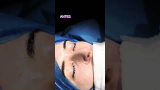 Rinoplastia Ultrasónica Natural en Argentina [upl. by Keelia]