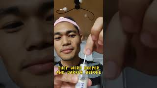 Applying Dr Leo Salicylic Acid Acne Drying Lotion [upl. by Glynis]