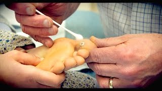 Freezing a HUGE PLANTAR WART with liquid nitrogen  Dr Paul [upl. by Gish]