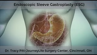 ESGEndoscopic Sleeve Gastroplasty Dr Tracy PittJourneylite Cincinnati [upl. by Cogan]