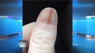 Melanoma on Your Nail [upl. by Nylessoj]