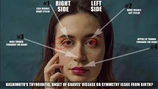 Hashimotos Thyroiditis – Graves Disease – Natural Symmetry [upl. by Samara339]