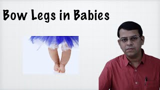 Bow legs in Babies [upl. by Drooff]