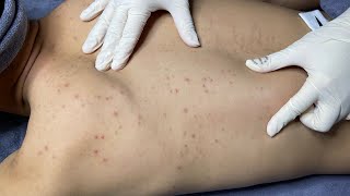 ACNE TREATMENT VU QUYNH MI Acne On Boys Shoulder 2024 [upl. by Eelanej626]