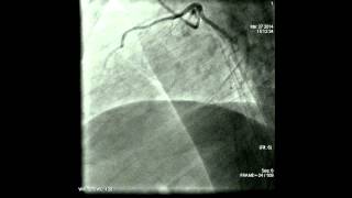 Coronary angiography procedure [upl. by Pitchford]