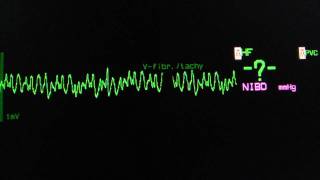 coarse ventricular fibrillation on an ECG heart monitor [upl. by Alastair]