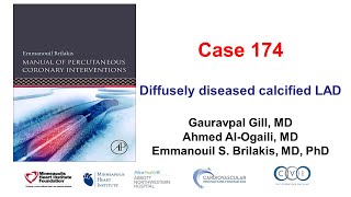 Case 175 Manual of PCI  Diffusely diseased calcified LAD [upl. by Holna]