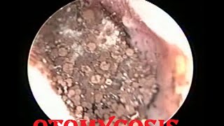 Severe fungal infection  Otomycosis ear cleaning [upl. by Ahsenad160]