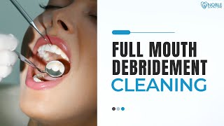 Full Mouth Debridement Cleaning [upl. by Gratia]