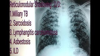 Reticulonodular shadowingopacity on Chest X Ray  Miliary Tuberculosis VS Sarcoidosis [upl. by Mohr]