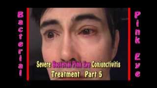 Severe Bacterial Pink Eye Conjunctivitis treatment part 5 [upl. by Webber814]