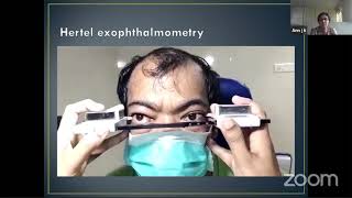 PG Orientation  Exophthalmometry  Dr Ann J K [upl. by Clarise]