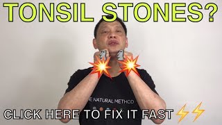 How to naturally get rid of tonsil stones [upl. by Infield]