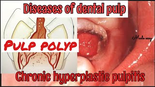 CHRONIC HYPERPLASTIC PULPITIS II PULP POLYP II DISEASES OF PULP II SERIES PART 4 II made easy [upl. by Virgil]