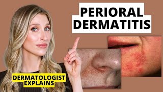 Dermatologist Explains Perioral Dermatitis What it Looks Like Causes amp Treatments  Dr Sam Ellis [upl. by Ecinnahs]