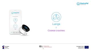 Lungs auscultation  coarse crackles 3 [upl. by Kilian140]