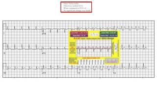 EKG Concepts  12 Lead EKG  Case Study 02 [upl. by Kotick201]